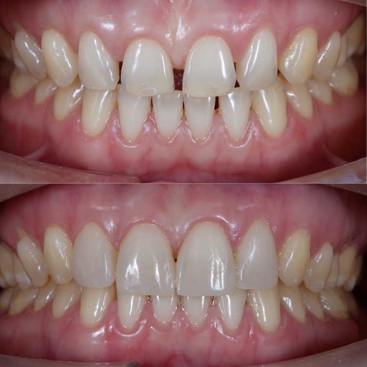 Now get back your beautiful smile by repairing chips and closed spaces between the teeth with our latest pain-free Cosmetic Composite Filling in Preston. Schedule your free telephone consultation at our clinic for advice and information on the right treatment for you.
